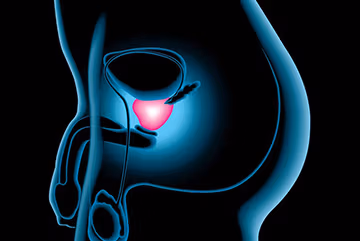 Prostatectomía Laparoscópica
